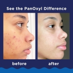 PanOxyl 10% Benzoyl Peroxide Acne Foaming Wash, Maximum Strength, Daily Acne-Fighting Face and Body Cleanser, Face Wash to Clear, Treat and Prevent Acne Pimples and Stubborn Breakouts, 5.5 Oz Tube - Image 7