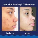 PanOxyl 10% Benzoyl Peroxide Acne Foaming Wash, Maximum Strength, Daily Acne-Fighting Face and Body Cleanser, Face Wash to Clear, Treat and Prevent Acne Pimples and Stubborn Breakouts, 5.5 Oz Tube - Image 7